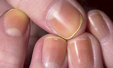 Hướng dẫn 3 cách trị dứt điểm móng ố vàng ngay tại nhà bằng nguyên liệu tự nhiên